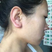 孕妇耳朵发炎影响胎儿（孕妇耳朵发炎影响胎儿）