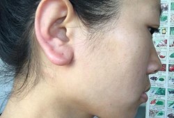孕妇耳朵发炎影响胎儿（孕妇耳朵发炎影响胎儿）