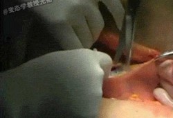 羊水破了还可以打无痛分娩针吗,胎儿窘迫可以顺产吗视频