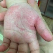 怀孕五个月，肚皮上长很多小红点，特别痒该怎么办,孕期肚子有红点点不痒