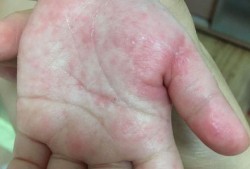 怀孕五个月，肚皮上长很多小红点，特别痒该怎么办,孕期肚子有红点点不痒