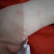 孕期臀部湿疹（小儿屁股湿疹）