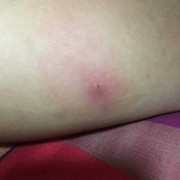 一岁多的宝宝腿上起一个大硬块怎么回事,胎儿肿块怎么确诊
