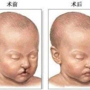 我女友是兔唇，家人怕遗传，强烈反对，我该怎么办,胎儿唇腭裂是怎么造成的