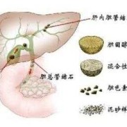 胎儿胆结石（胎儿胆结石怎么引起的）