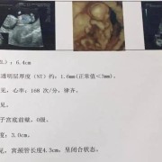 B超單上的NB和NT分別是什麽意思,胎儿b超NT是什么意思