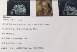 B超單上的NB和NT分別是什麽意思,胎儿b超NT是什么意思