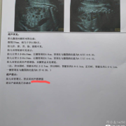 胎儿肾脏偏大问题大吗（胎儿肾脏偏大问题大吗）
