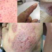 怀孕八个月得了蛇缠腰外用雄黄粉擦在皮肤上对胎儿有影响吗,孕期一直用皮肤外用药可以吗