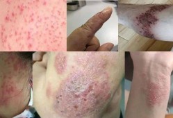 怀孕八个月得了蛇缠腰外用雄黄粉擦在皮肤上对胎儿有影响吗,孕期一直用皮肤外用药可以吗