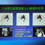 胎儿血管粗（主动脉示不规则增粗是怎么回事）