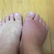 孕期患痛风（孕期 痛风）