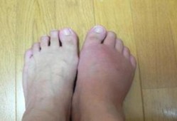 孕期患痛风（孕期 痛风）
