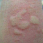 孕期得过敏性皮炎（孕妇荨麻疹怎么办）