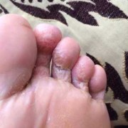 孕期脚气脚痒怎么办啊（怀孕了脚气很痒怎么办，怀孕了脚气发作怎么办）