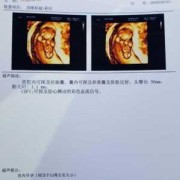 11周的胎儿会动吗（怀孕11周了头臀径大概多少是正常的）