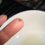 孕期结石（孕期结石疼怎么办）