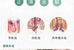 孕期外痔如何消肿（外痔可能是血栓痔，如何尽快消肿止痛）