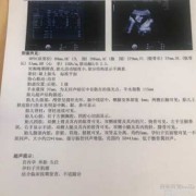 胎儿符合孕35周，但是腹腔内肠管增宽，较宽处内径约21mm，腹腔内部局部回声增强。请问考虑什么情况,胎儿肠管增宽一般都是什么问题