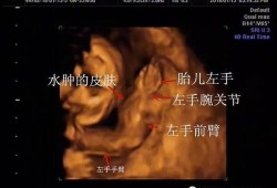 胎儿会骨折吗（胎儿会骨折吗在肚子里）