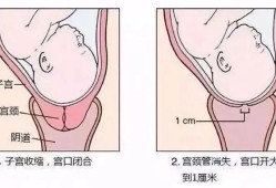 孕5个月宫颈长度短怎么办,孕期宫颈短怎么长上去