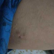 孕晚期大腿内侧长湿疹的很痒怎么治疗,孕期腿上长癣怎么办