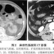 胎儿肠道积液的原因（胎儿肠道积液的原因有哪些）