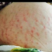 孕期肚皮发痒（孕期肚皮发痒是怎么回事）