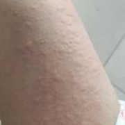 怀孕了得荨麻疹怎么办,孕期荨麻疹症状图片大全