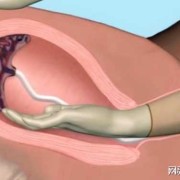 胎盘剥离胎儿能保住吗（胎膜剥离能自然长好吗）