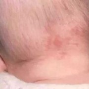 孕妇怎样避免胎儿胎记（孕妇撞到肚子会有胎记吗）