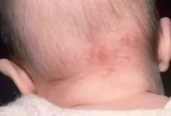 孕妇怎样避免胎儿胎记（孕妇撞到肚子会有胎记吗）