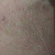 孕晚期大腿内侧长湿疹的很痒怎么治疗,孕期大腿内侧痒痒越抓越痒有小红疙瘩