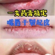 孕妇嘴唇干裂脱皮怎么办,孕妇唇干裂怎么办