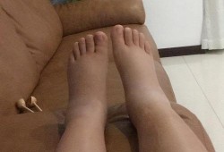 脚胖是哪样的,孕期脚胖了还能恢复吗