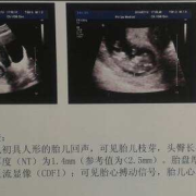 孕38周胎心监护多少算正常,38周胎儿b超数据标准对照表