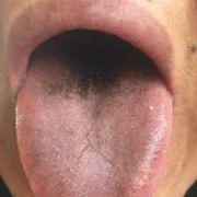 孕期舌头发黑怎么回事（孕期舌头发黑怎么回事）