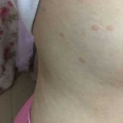 孕期乳房周围斑点（孕期乳房周围斑点怎么回事）
