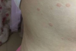 孕期乳房周围斑点（孕期乳房周围斑点怎么回事）