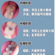 孕妇龋齿很严重咋办,孕期龋齿疼的厉害怎么办