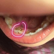 孕期牙齿坏了怎么办,孕期牙齿掉了一小块是缺钙吗