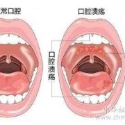 孕期口腔溃疡（孕期口腔溃疡怎么办最快最有效的方法）
