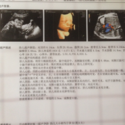 胎儿系统超声检查是什么（32周系统彩超检查什么）