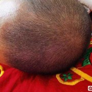新生儿头上干干净净的，没有头痂好吗,胎儿全或无是什么意思