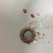 孕期刷牙出血（孕期刷牙出血怎么回事）