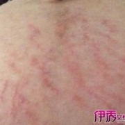 怀孕了皮肤过敏很痒怎么办,怀孕期间过敏了怎么办啊
