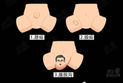 孕期疝气怎么办（疝气是怎么引起的孕妇）