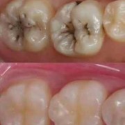 怀孕能补牙吗,怀孕补牙吗