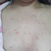 怀孕期间痤疮（怀孕长痘痘怎么回事）