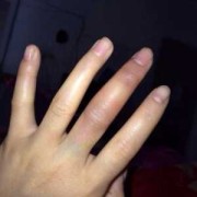 孕期手肿了（怀孕32周手指肿了，怎么回事）